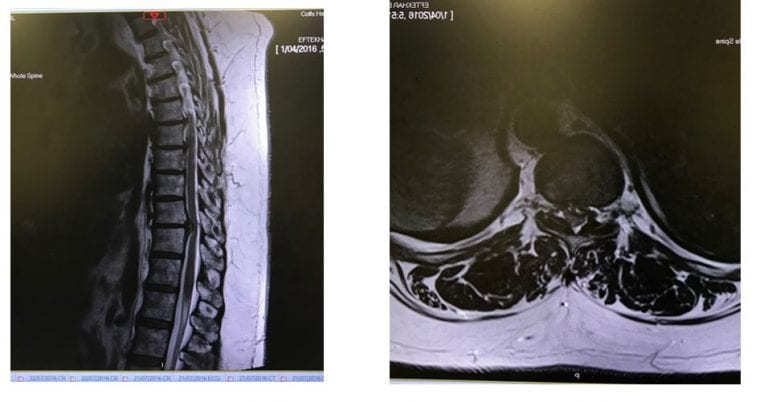 Thoracic Disc Herniation