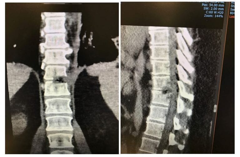 Thoracic Disc Herniation